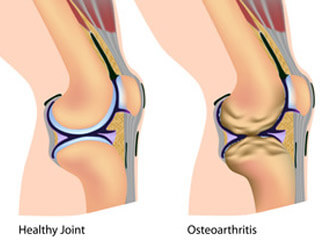 Osteo Arthritis (OA) of The Knees