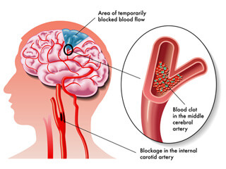 The Transient Ischemic Attack; A Warning And An Opportunity