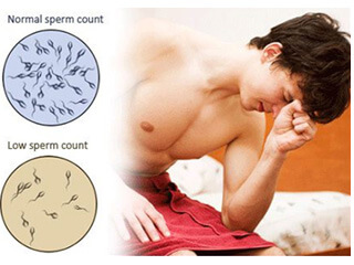 Low Sperm Count – Oligospermia