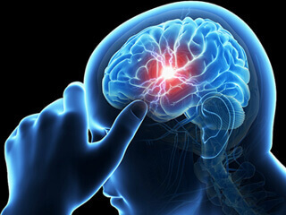 Reducing Stroke Risks