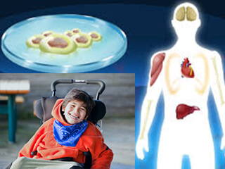 Cerebral Palsy and Stem Cell Therapy