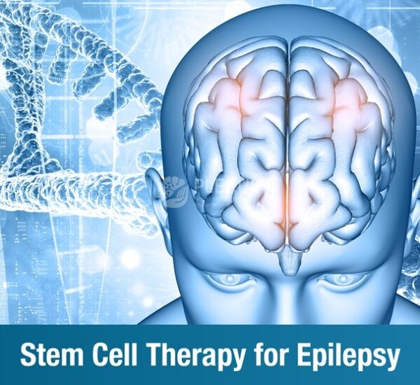 Stem Cell Therapy for Epilepsy