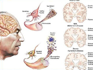 Nutrition in Motor Neuron Disease