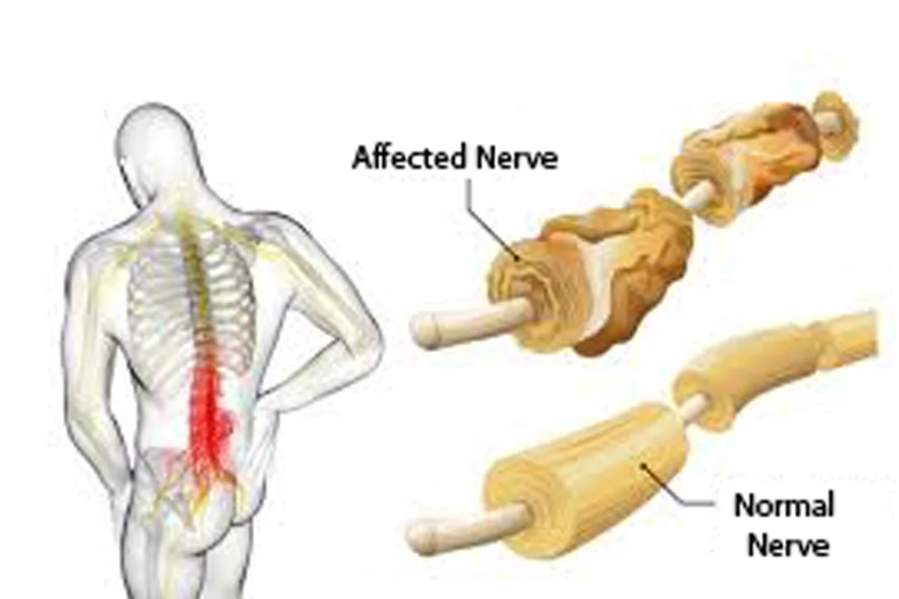 Guillain Barre Syndrome Gbs Plexus