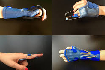 Splints in Occupational Therapy (Hand Rehabilitation)