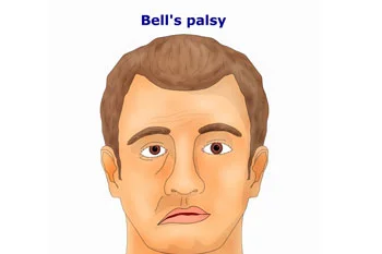 palsy bell face bells