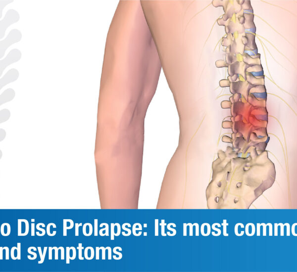 Everything you need to know about Disc Prolapse