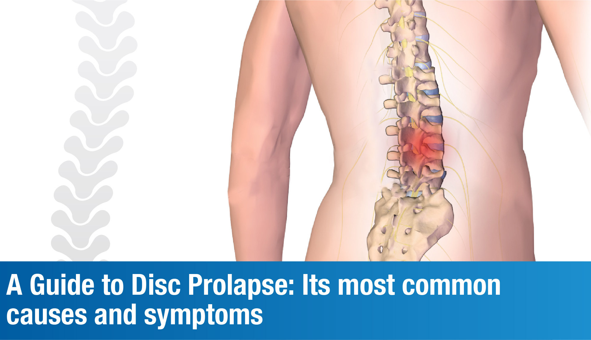 Everything you need to know about Disc Prolapse