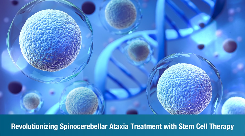 Revolutionizing Spinocerebellar Ataxia Treatment with Cell Therapy