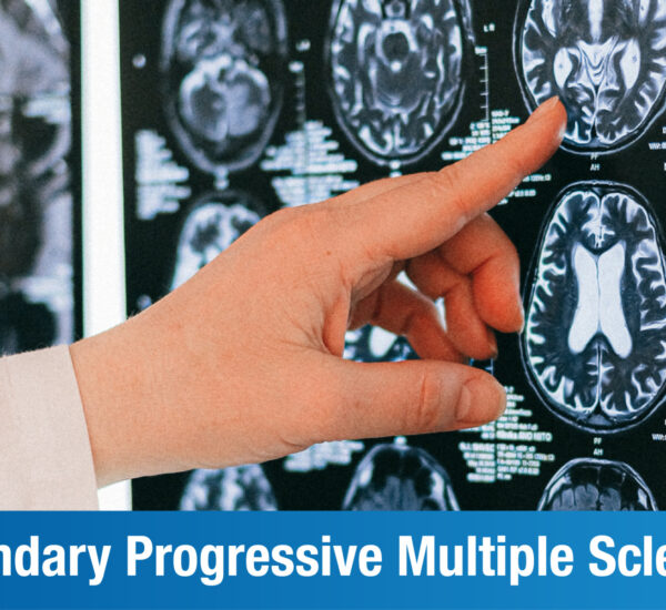 Secondary Progressive Multiple Sclerosis: Causes, Symptoms & Treatment