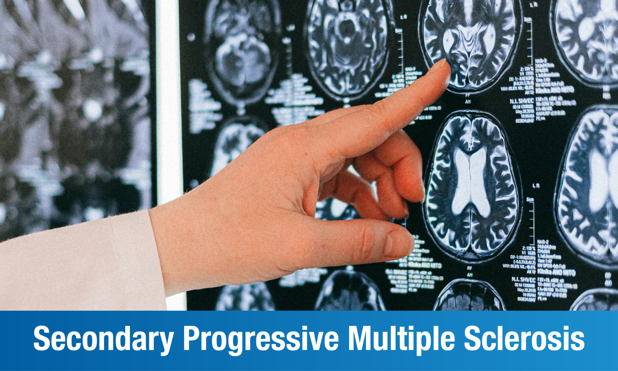 Secondary Progressive Multiple Sclerosis: Causes, Symptoms & Treatment