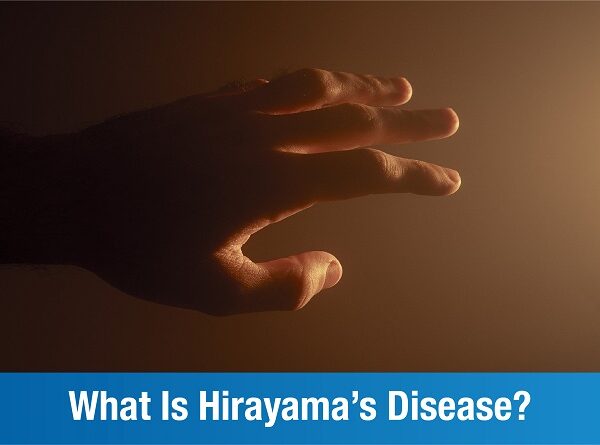 What is Hirayama’s Disease? An Overview