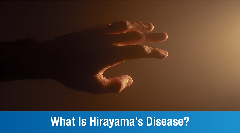 What is Hirayama’s Disease? An Overview