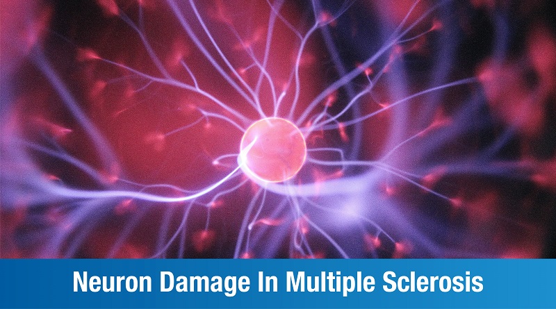 Nerve Damage in Multiple Sclerosis: