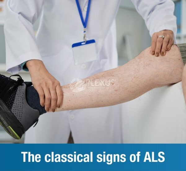 The classical signs of ALS
