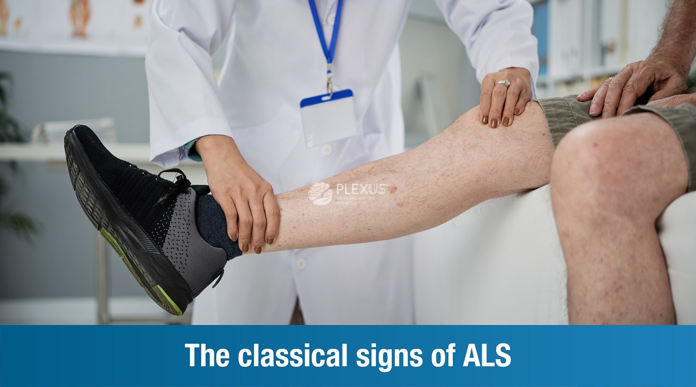 The classical signs of ALS