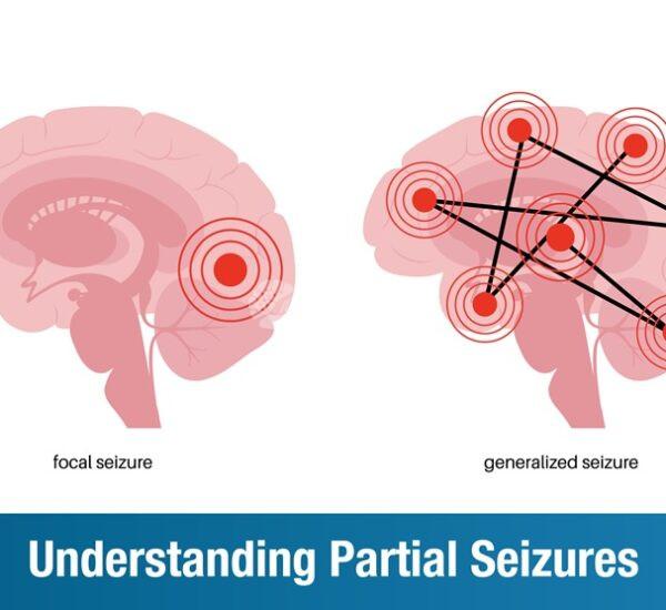 Understanding Partial Seizures