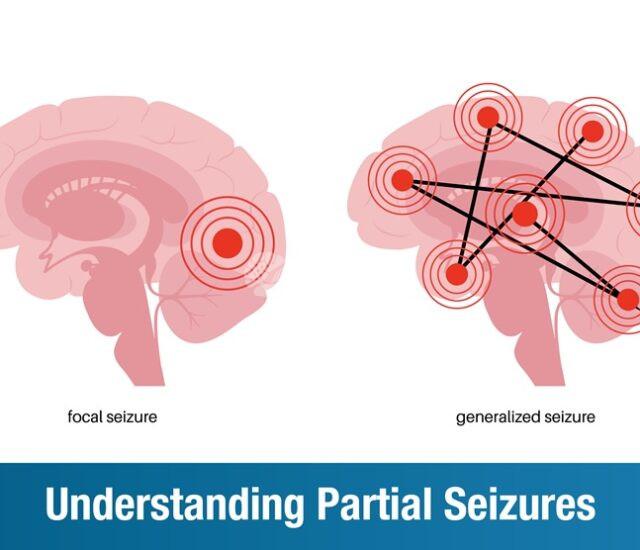 Understanding Partial Seizures