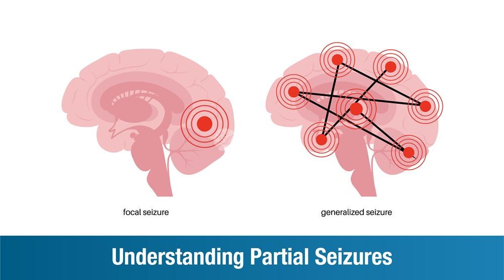 Understanding Partial Seizures