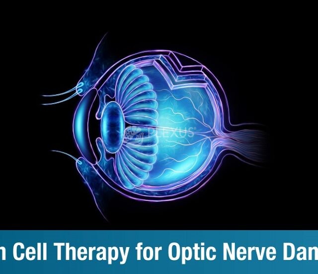Stem Cell Therapy for Optic Nerve Damage