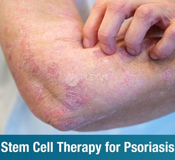 Stem Cell Therapy for Psoriasis