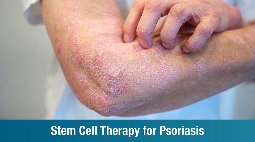 Stem Cell Therapy for Psoriasis