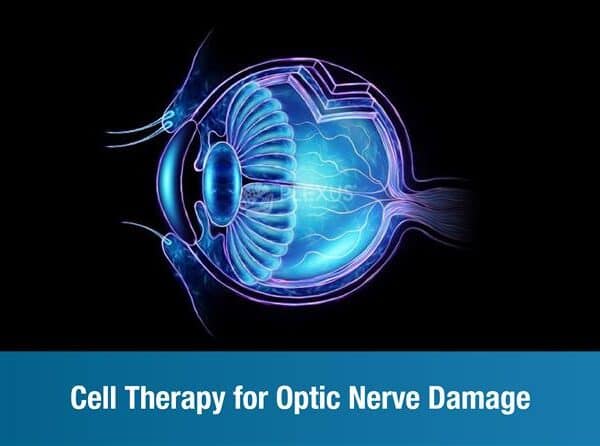 Understanding Regenerative Cell Therapy for Optic Nerve Damage