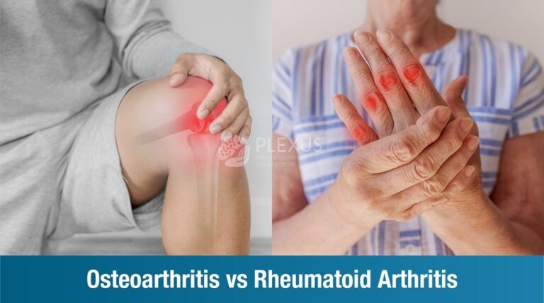 Osteoarthritis Vs Rheumatoid Arthritis | Plexus