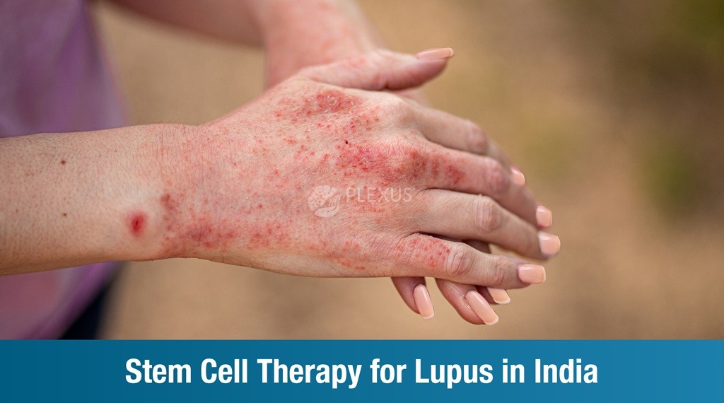 Stem Cell Therapy for Lupus in India