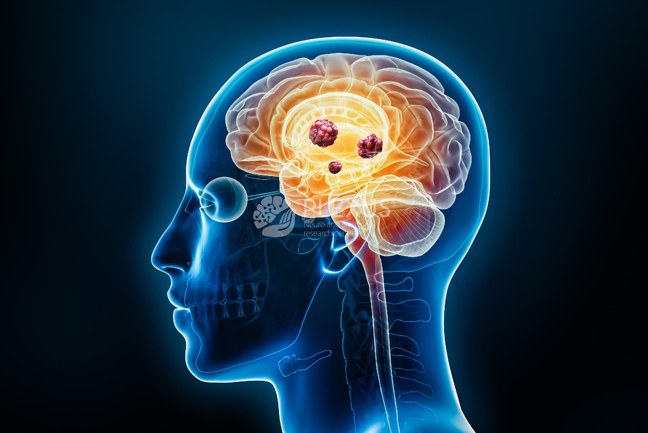 Causes of Spinocerebellar Ataxia 2 min