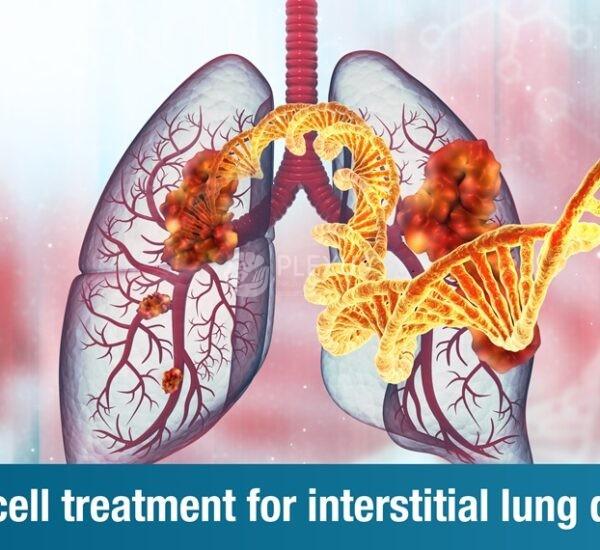 Living With Interstitial Lung Disease: Explore Stem Cell Therapy to Improve Quality of Life