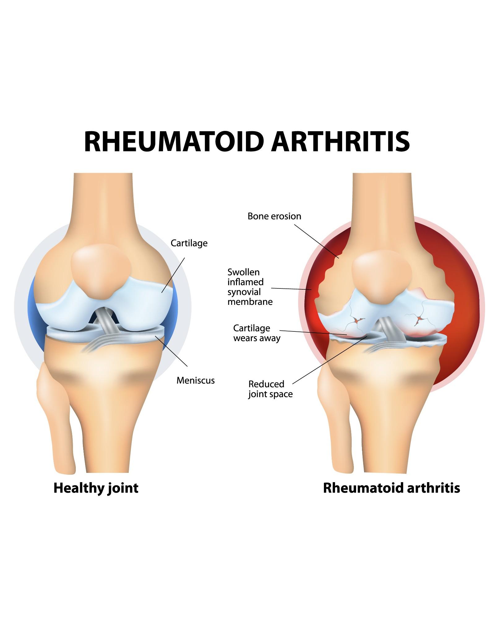 Rheumatoid arthritis causes