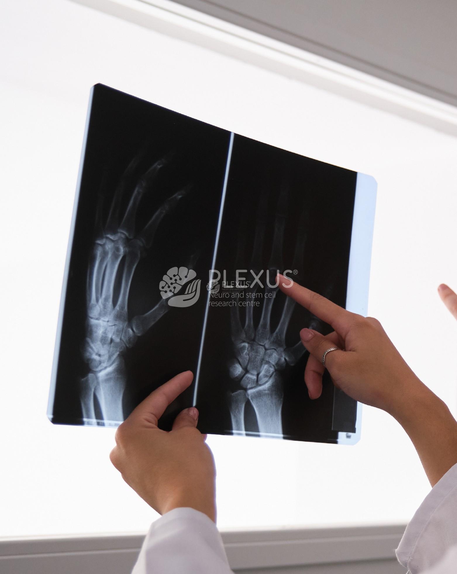 Rheumatoid arthritis diagnosis