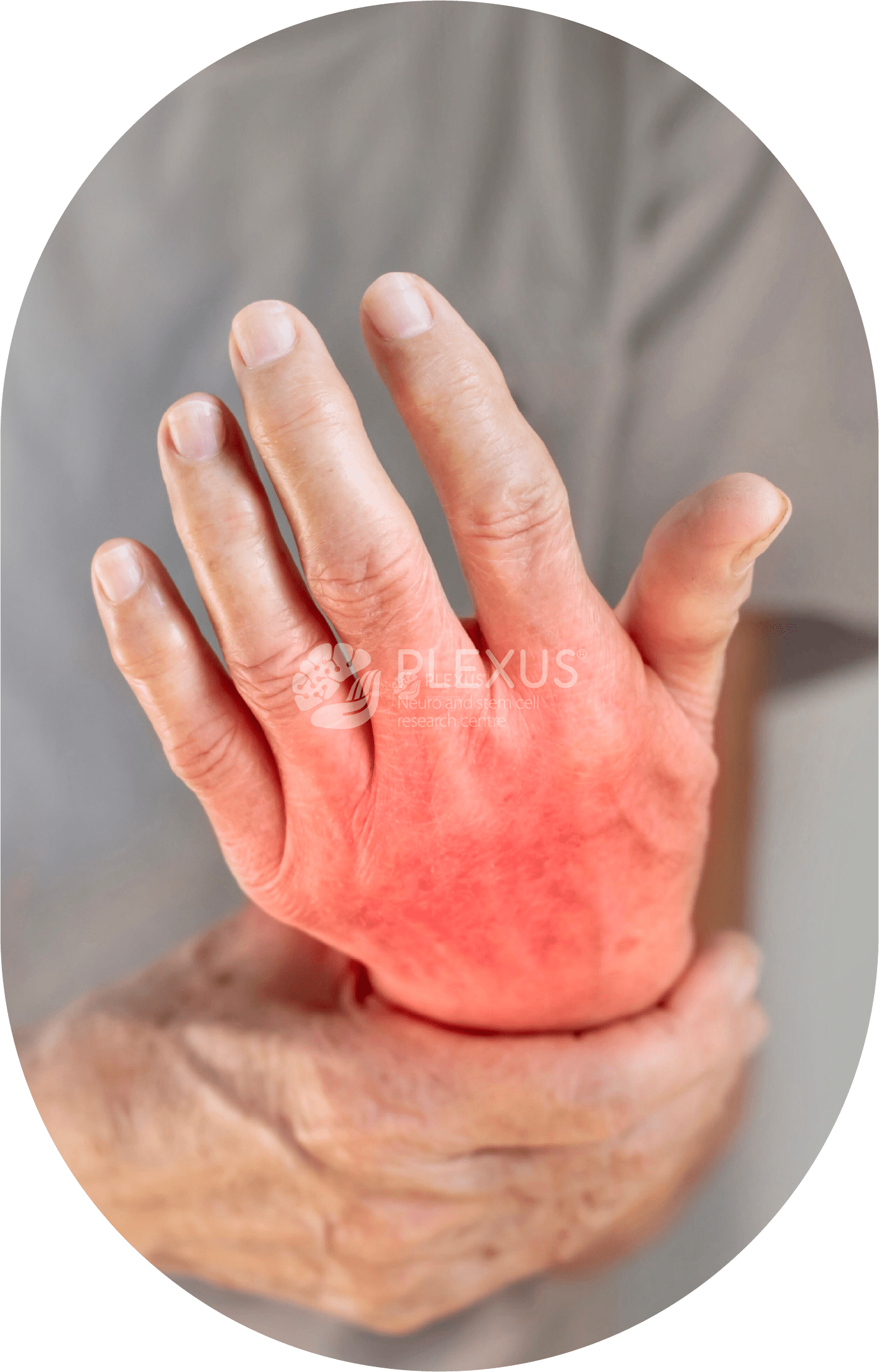 Rheumatoid arthritis