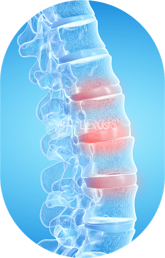 Spinal Cord Injury Treatment in Hyderabad