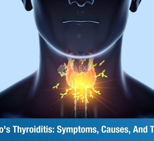 An Overview of Hashimoto’s Thyroiditis