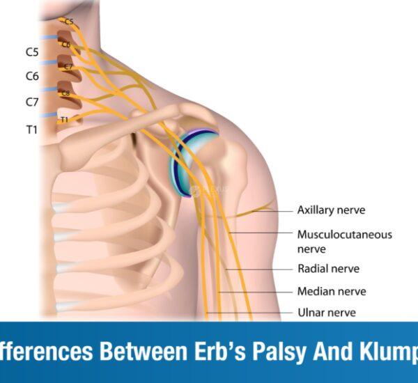 Erb’s Palsy vs. Klumpke’s Palsy – An Overview Decode the difference