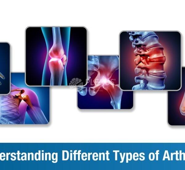 Understanding Different Types of Arthritis