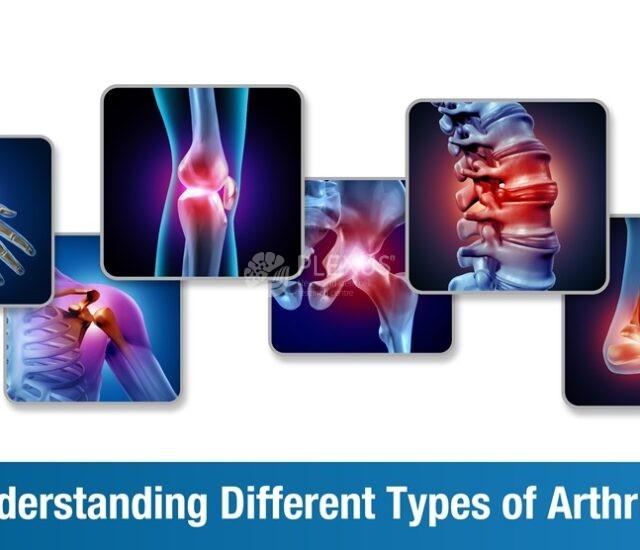 Understanding Different Types of Arthritis