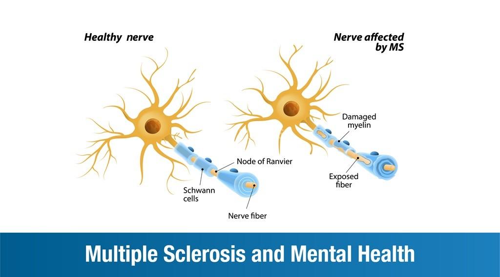 Multiple Sclerosis and Mental Health