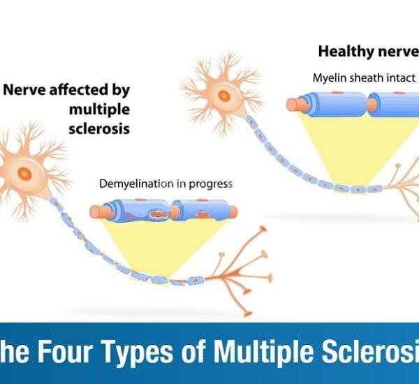 The Four Types of Multiple Sclerosis