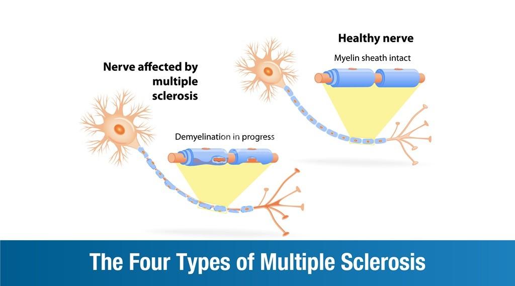 The Four Types of Multiple Sclerosis