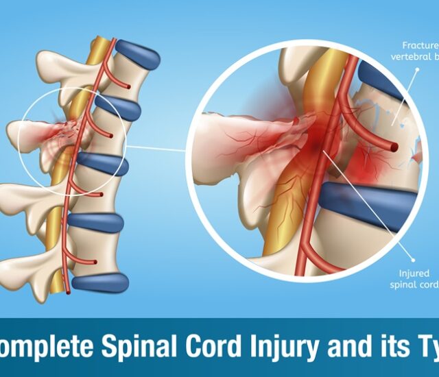 Incomplete Spinal Cord Injury : Types, Symptoms, Recovery, and Rehabilitation