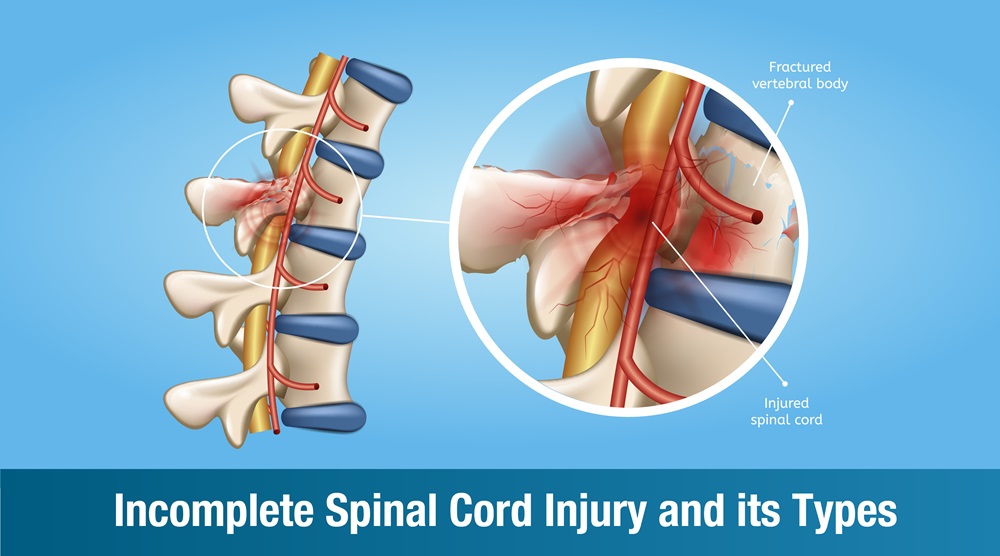 Incomplete Spinal Cord Injury : Types, Symptoms, Recovery, and Rehabilitation