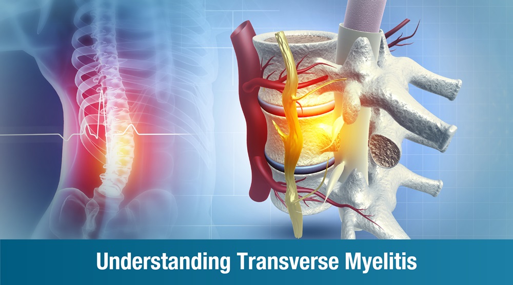 Understanding Transverse Myelitis: Causes, Symptoms, Treatment, and Recovery