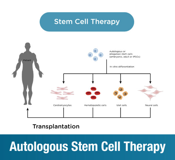 Autologous Stem Cell Therapy: Transforming Your Life with Your Own Cells