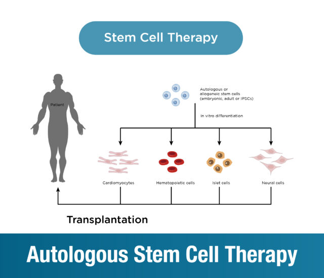 Autologous Stem Cell Therapy: Transforming Your Life with Your Own Cells