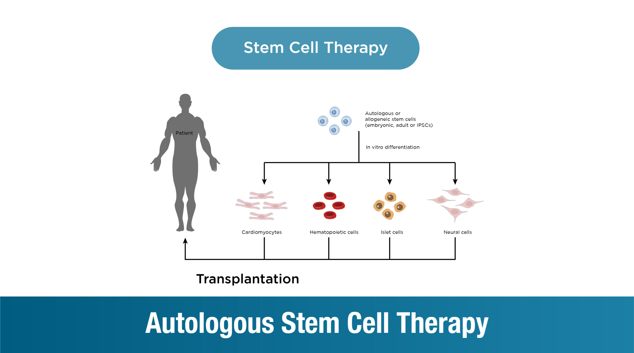 Autologous Stem Cell Therapy: Transforming Your Life with Your Own Cells