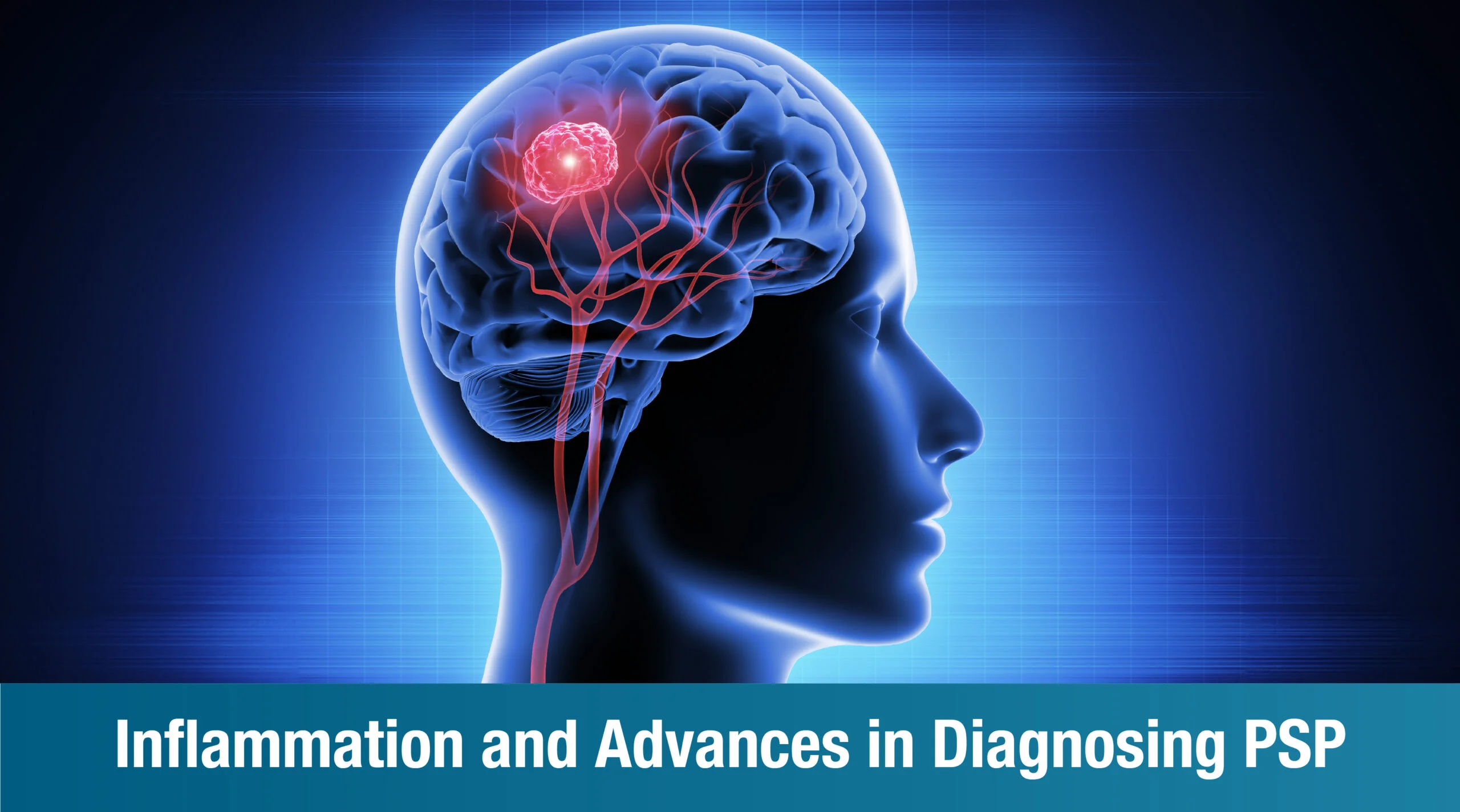 Understanding Progressive Supranuclear Palsy: Key Facts and Emerging Treatments