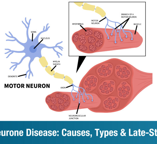 Understanding Motor Neurone Disease: Causes, Types, and How to Manage the Later Stages